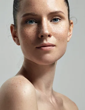 woman with freckles in her skin