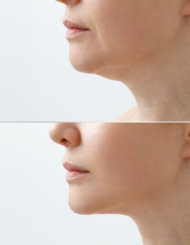 portrait of a woman before and after double chin targeted procedure